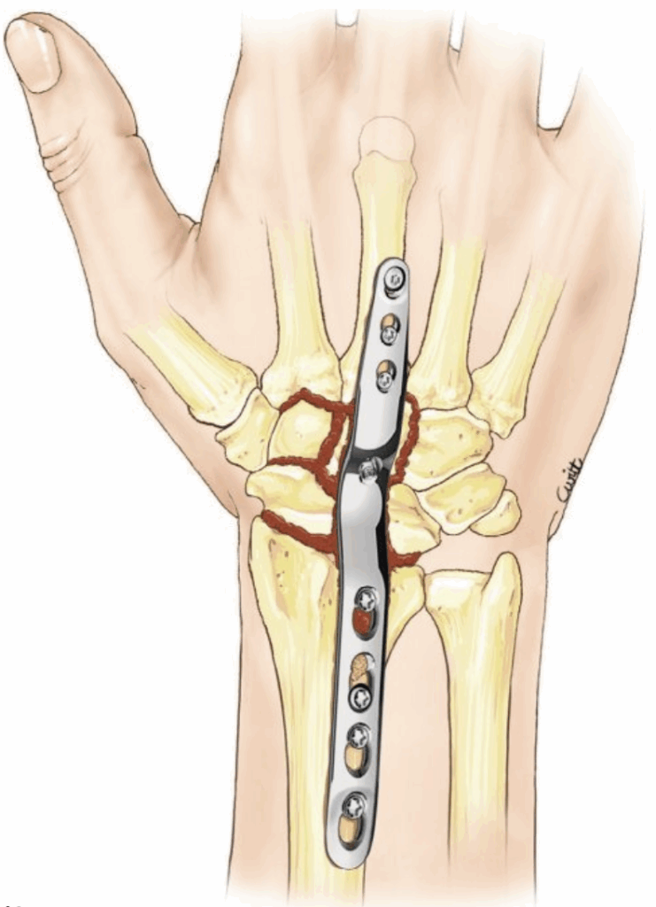 Arthrodèse du poignet