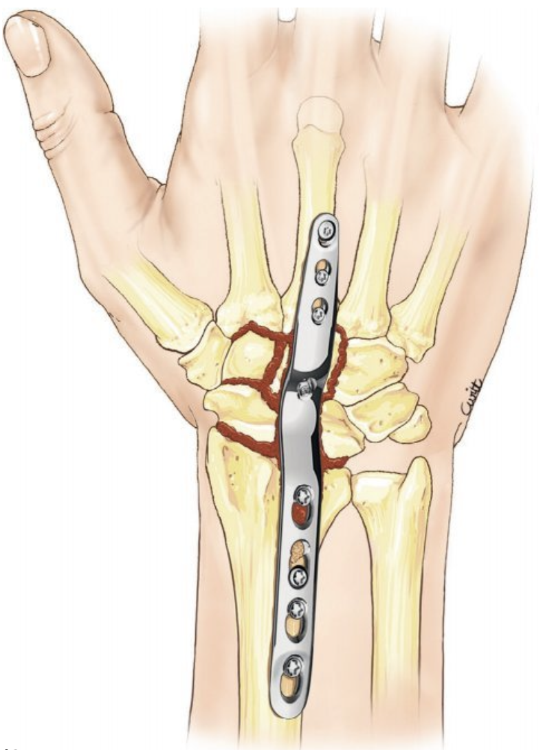 Arthrodèse du Chirurgie de l'arthrose du — free download